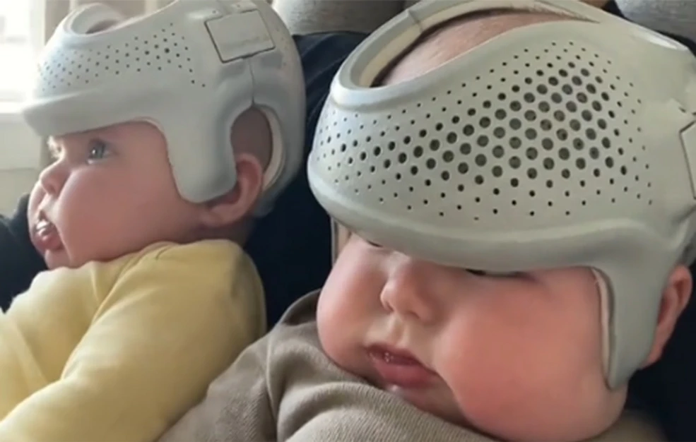 Μητέρα φοράει στα μωρά της κράνη για 23 ώρες το 24ωρο – Αντιδράσεις στα social media