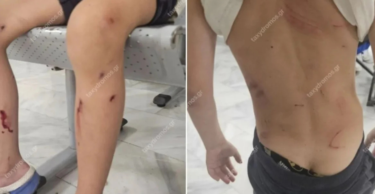 Βόλος: Από θαύμα γλίτωσε 7χρονος όταν του επιτέθηκαν αδέσποτα σκυλιά